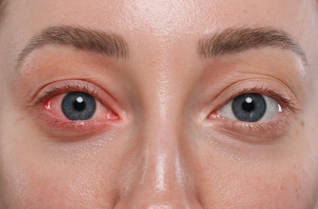 Close-up of a person's face, one eye is healthy, and the other eye is red and irritated.