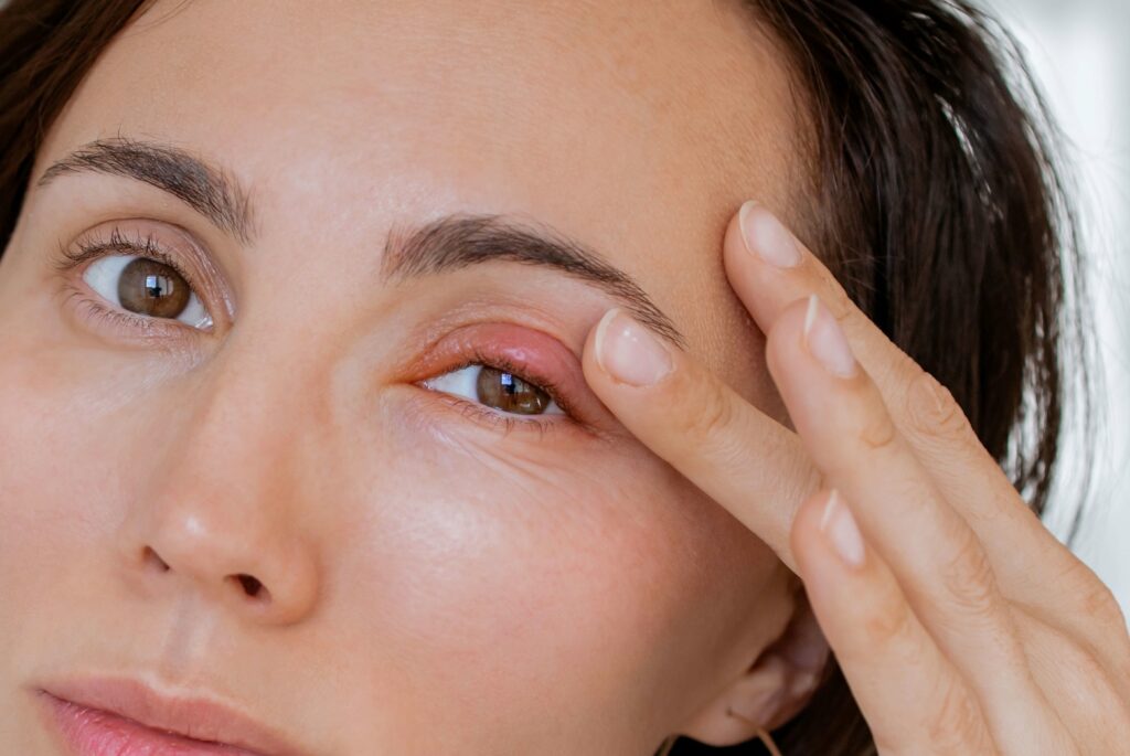 A close-up of a person's face as they gently touch a red eye stye.