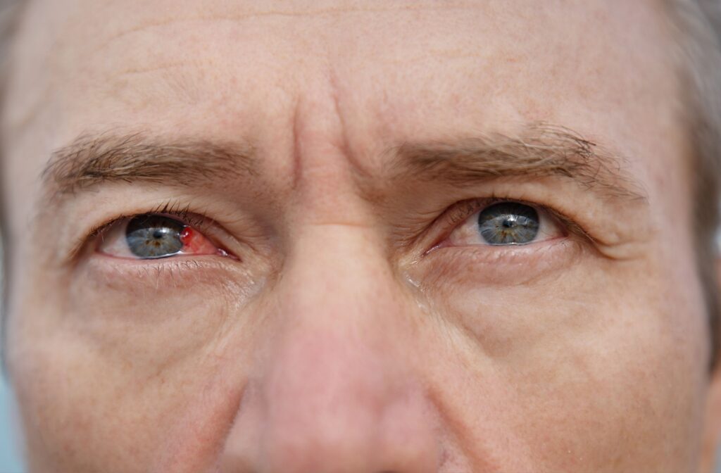 Close-up of older man's eye, with right eye red.