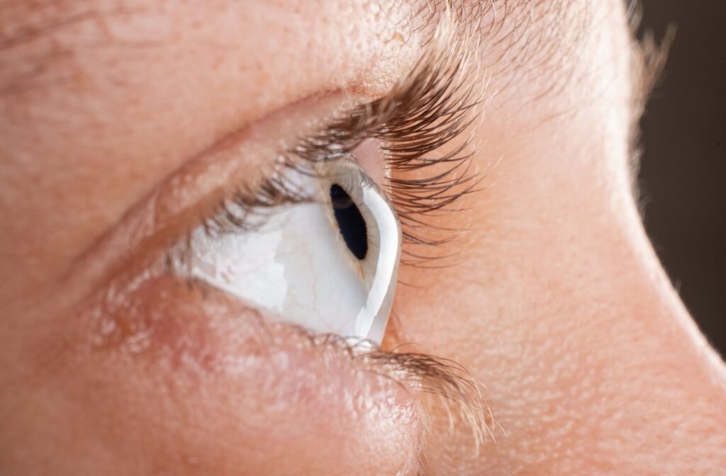 Close-up view of a scleral contact lens resting on a patient’s eye, showing how it vaults over the cornea.