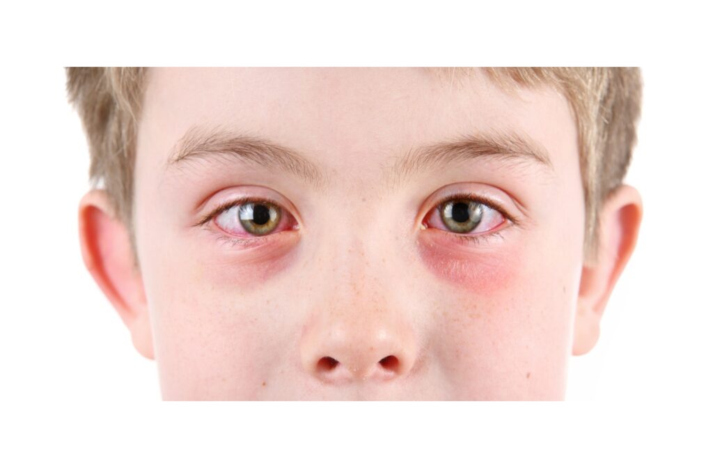 Close-up of a child’s face showing red, swollen, and irritated eyes typical of conjunctivitis.