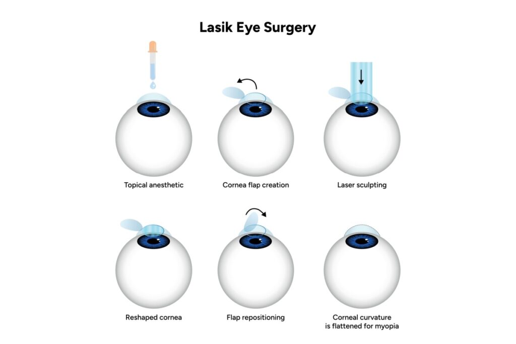 Step-by-step LASIK eye surgery diagram showing topical anesthetic, cornea flap creation, laser sculpting, reshaped cornea, flap repositioning, and corrected corneal curvature for myopia.