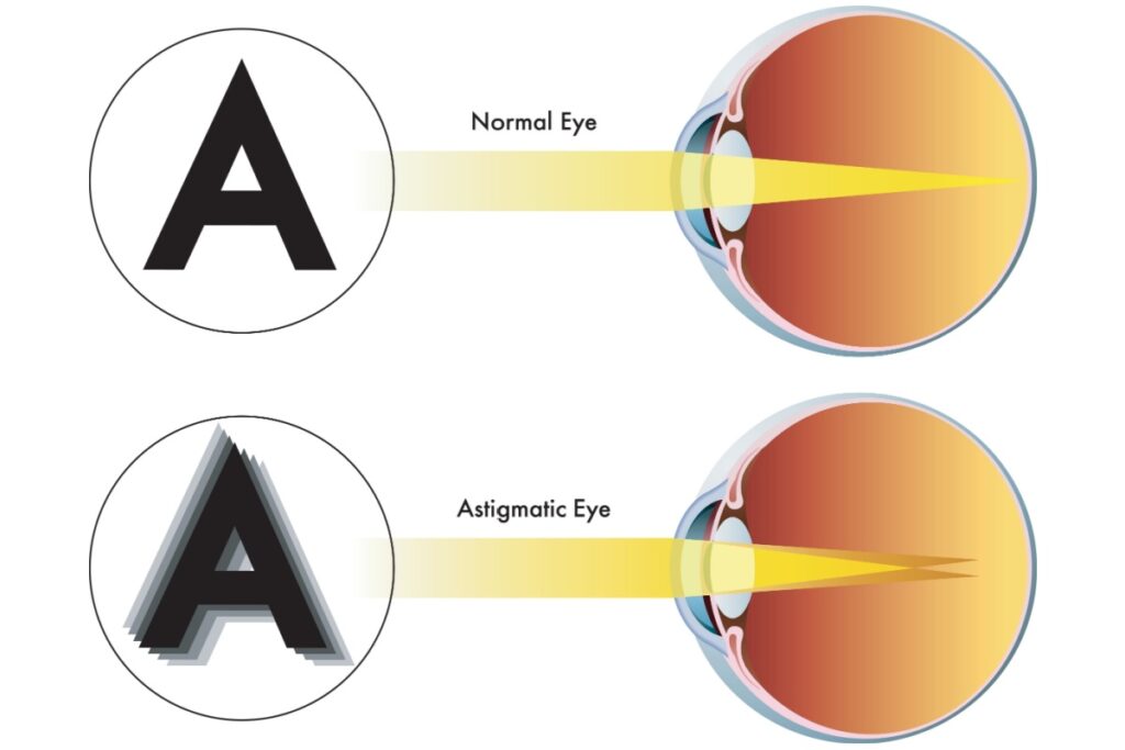 Illustration comparing normal vision and astigmatism. The top image shows clear focus on the retina, while the bottom shows distorted vision from uneven corneal curvature.