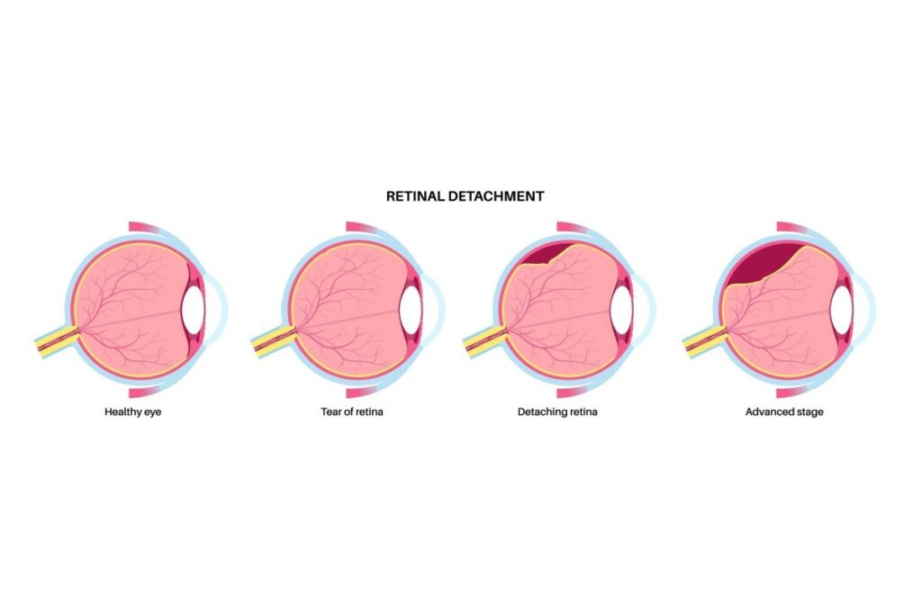 A medical illustration titled 'RETINAL DETACHMENT' showing four stages of eye health. The first is a 'Healthy eye' with an intact retina. The second shows a 'Tear of retina' with a small break in the inner lining. The third shows a 'Detaching retina' where the lining starts to lift away from the back of the eye. The fourth shows an 'Advanced stage' where a large portion of the retina is detached and fluid has accumulated behind it.